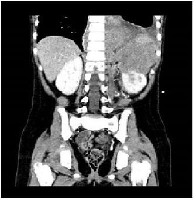 Hemorrhage During Induction Chemotherapy in Neuroblastoma: Additional Risk Factors in High-Risk Patients